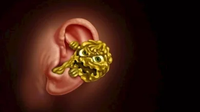 تراكم شمع الأذن الزائد